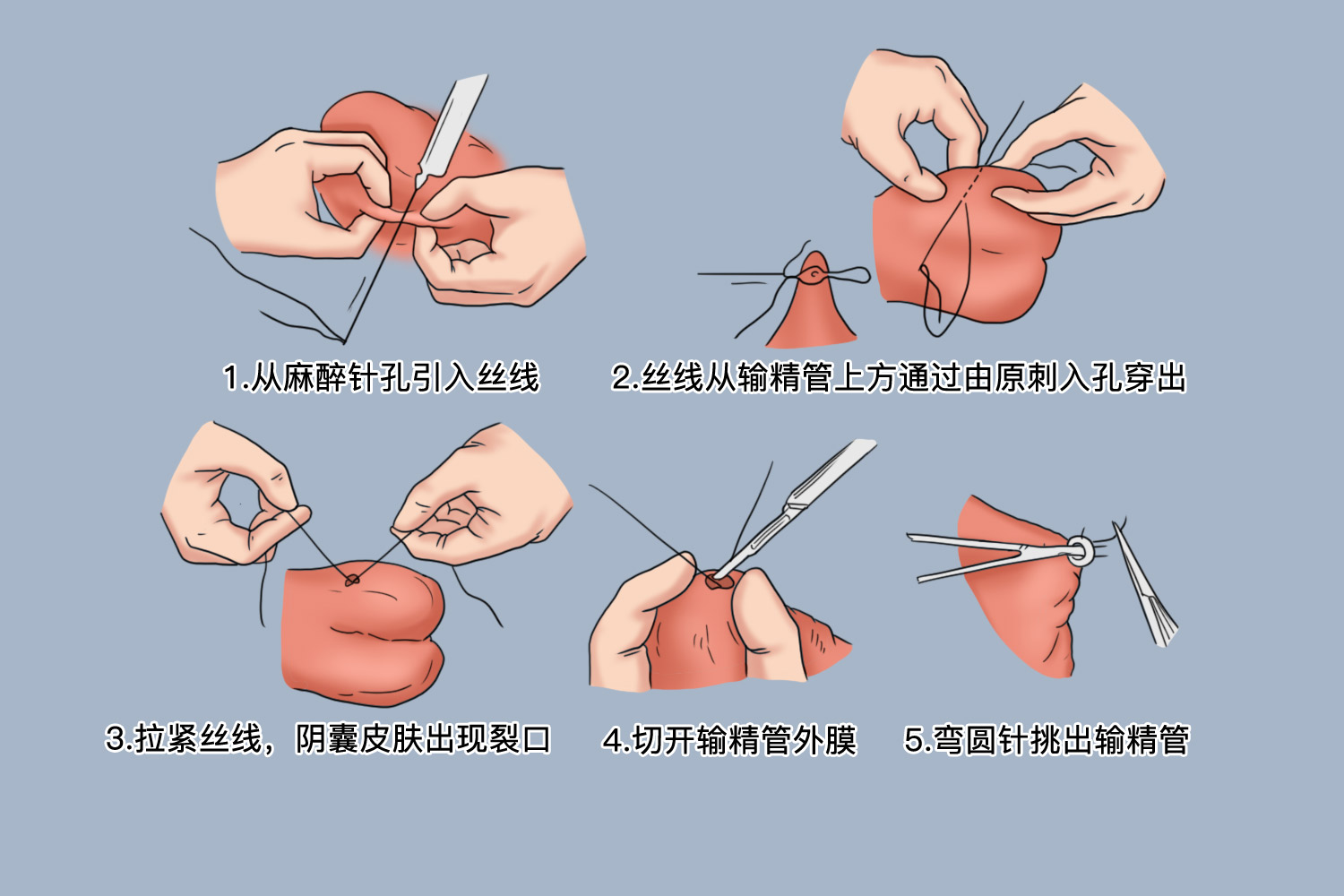 精神病结婚合法吗 结扎手术影响有哪些