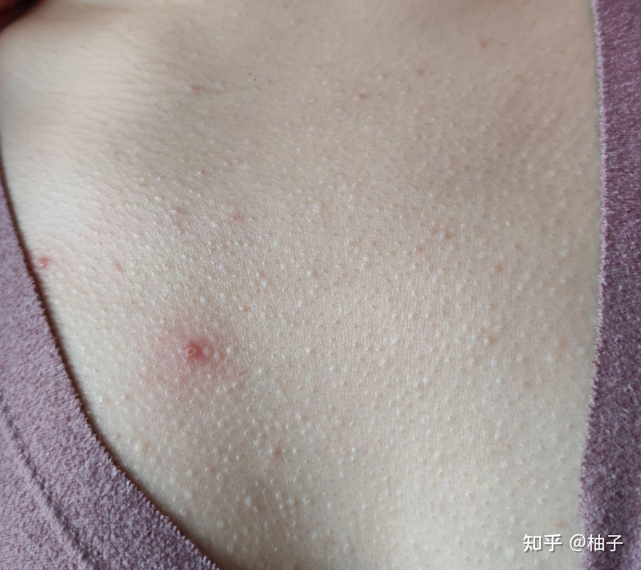 皮肤疙瘩困扰 身体白色疙瘩处理办法