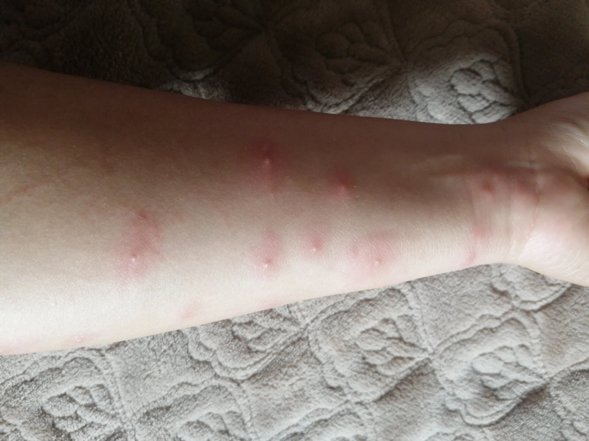 黑色飞蚁咬人很痒起水泡 隐翅虫毒性比眼镜蛇强