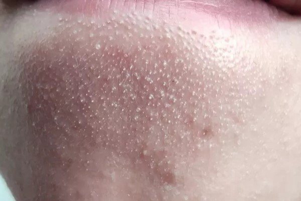 “一夜白头”的科学解释是什么?...