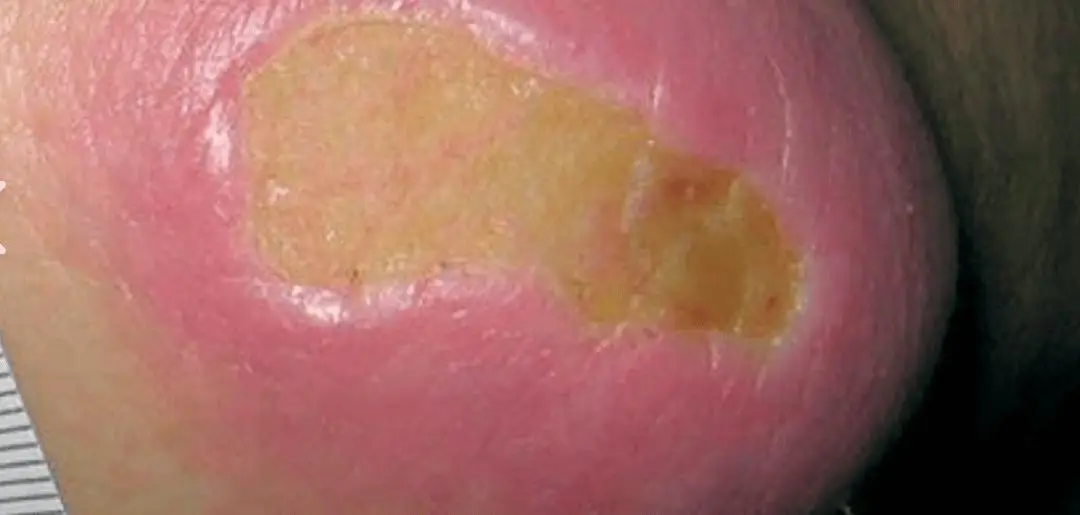 慢性伤口为何癌变 如何预防癌症发生