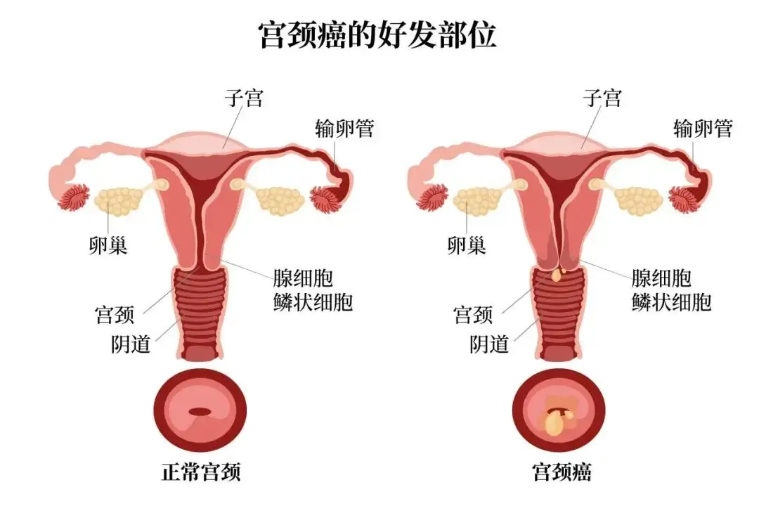 宫颈癌疫苗深度解读,疫苗是否管用?...